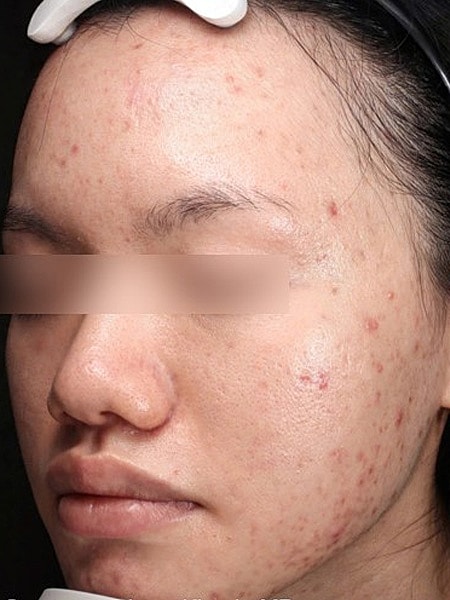 UltraClear Before & After