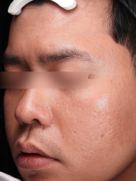 UltraClear Before & After
