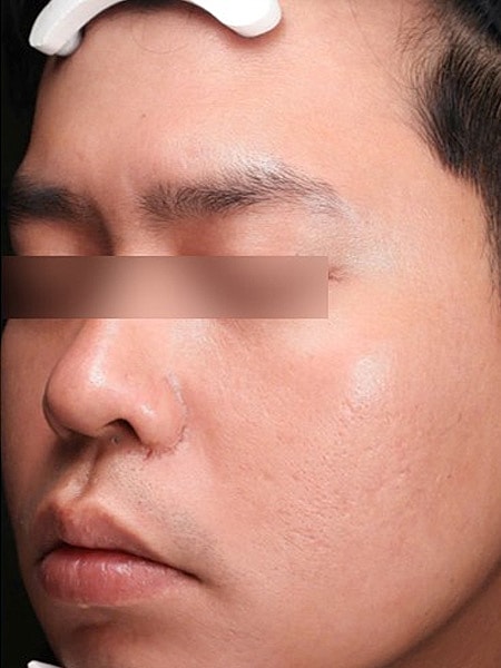 UltraClear Before & After