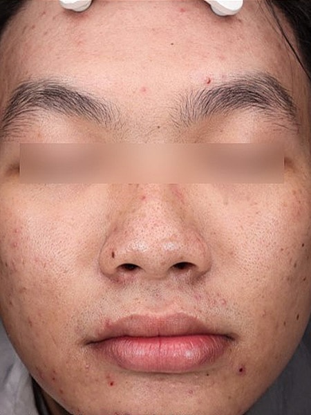 UltraClear Before & After
