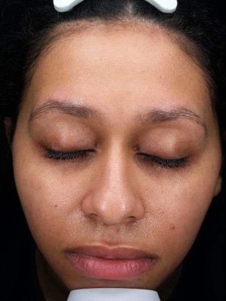 UltraClear Before & After