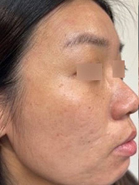 UltraClear Before & After