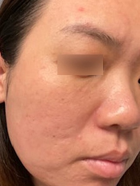 UltraClear Before & After