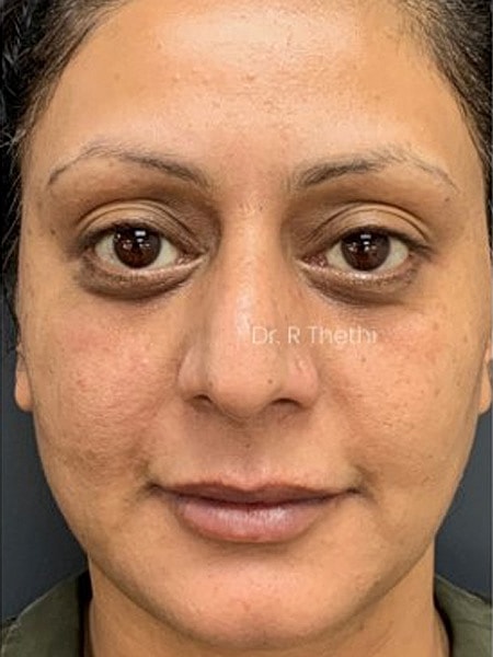 UltraClear Before & After