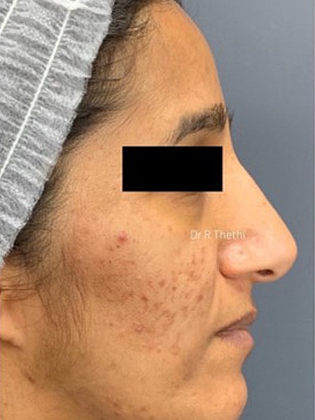 UltraClear Before & After