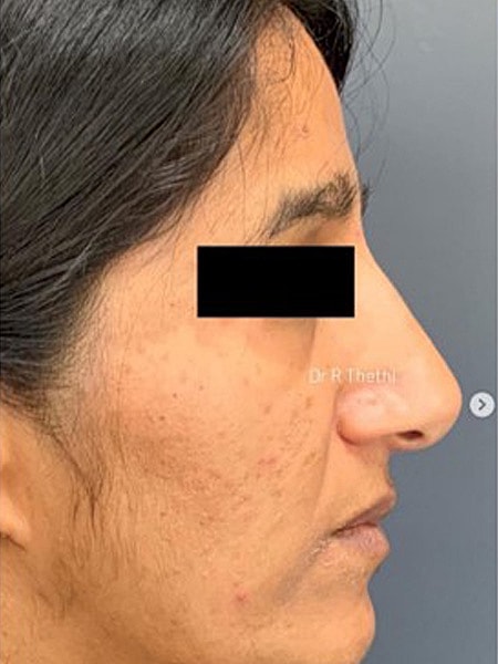 UltraClear Before & After