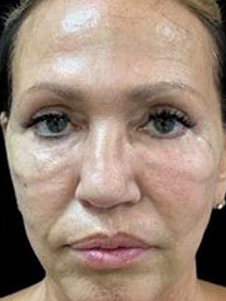 UltraClear Before & After