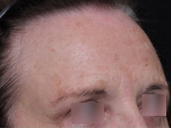 UltraClear Before & After