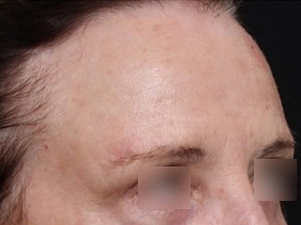 UltraClear Before & After