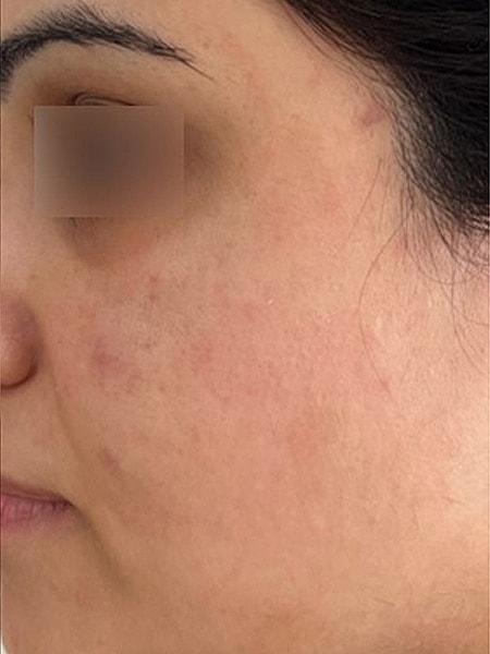 UltraClear Before & After