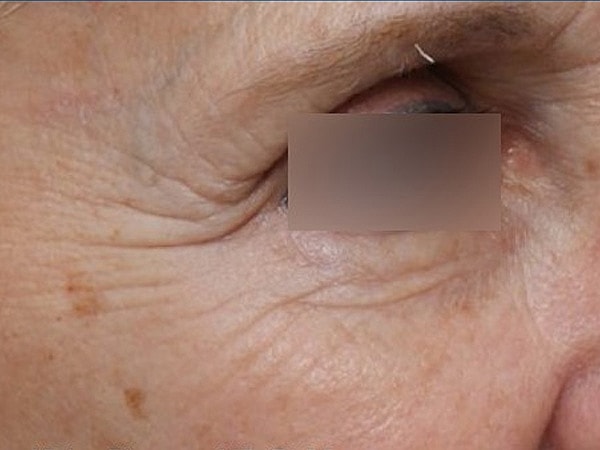 UltraClear Before & After