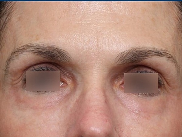 UltraClear Before & After