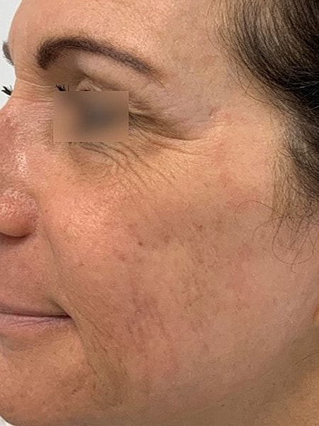 UltraClear Before & After