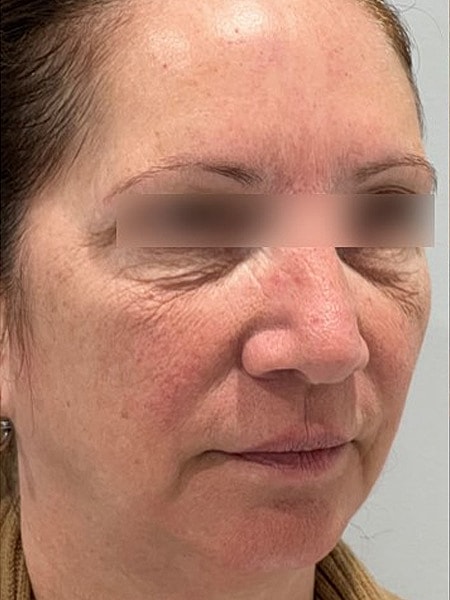 UltraClear Before & After