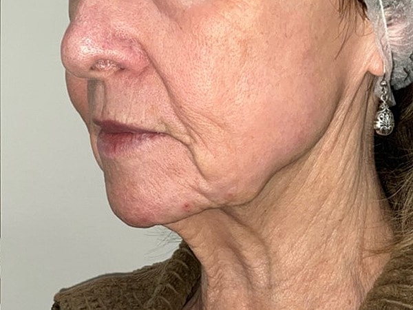 UltraClear Before & After