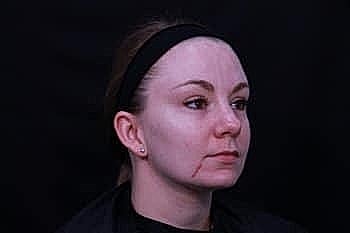 Woman with facial scar against dark background.