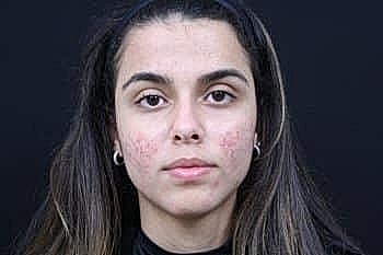 Young woman with skin imperfections on her face.