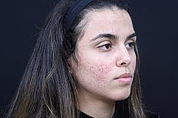 Young woman with acne on dark background.