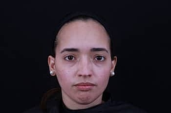 Skin Rejuvenation Before & After