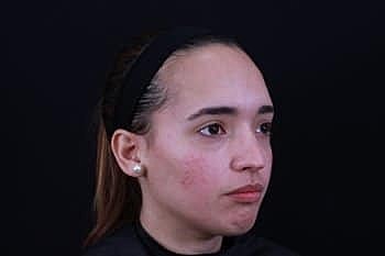 Skin Rejuvenation Before & After