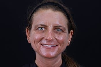 Skin Rejuvenation Before & After