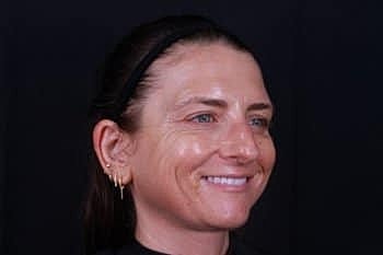 Skin Rejuvenation Before & After