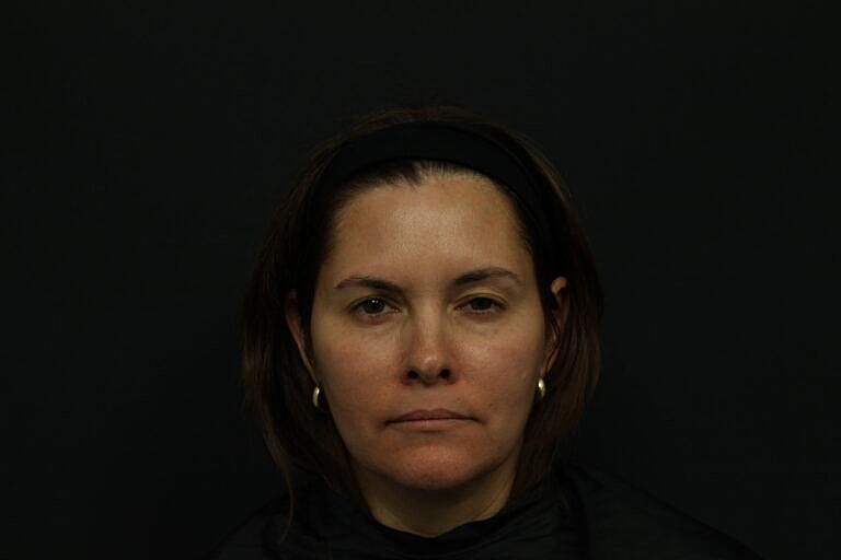 Skin Rejuvenation Before & After