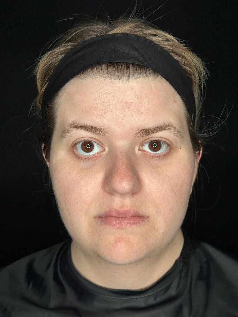 Skin Rejuvenation Before & After