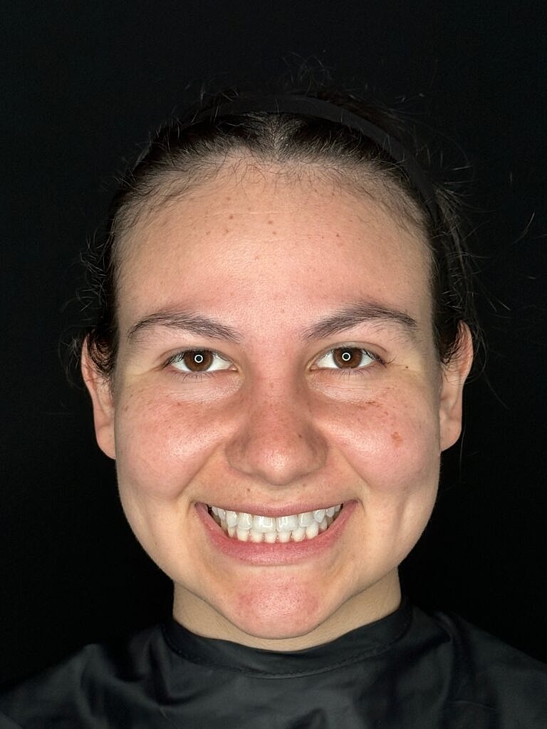 Skin Rejuvenation Before & After