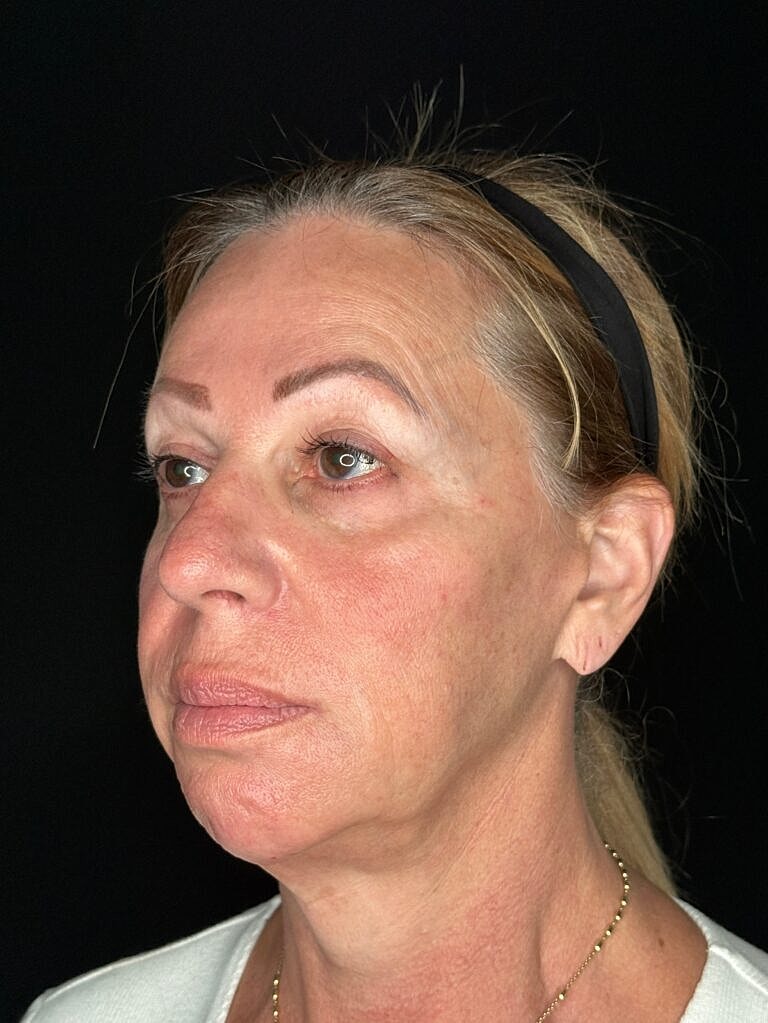 Skin Rejuvenation Before & After