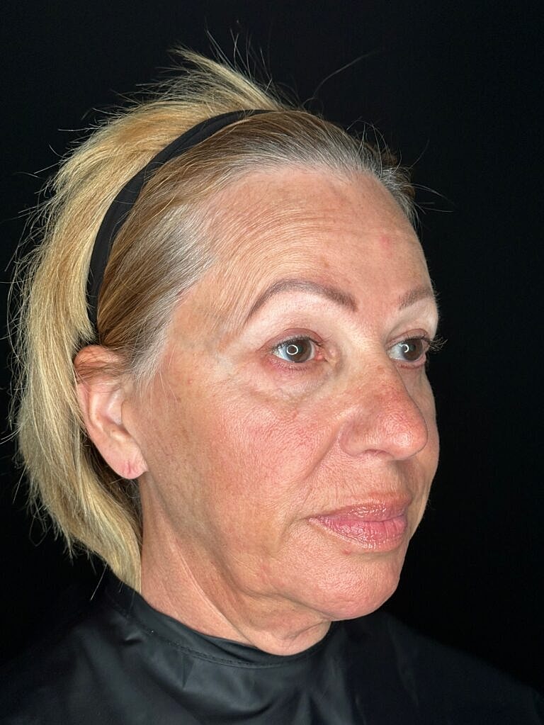 Skin Rejuvenation Before & After