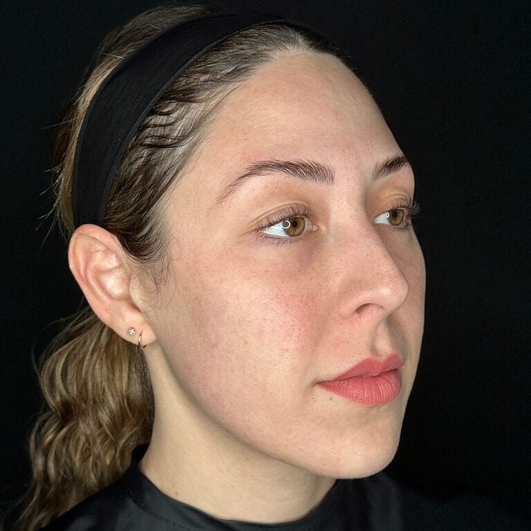 Skin Rejuvenation Before & After