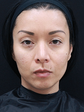Skin Rejuvenation Before & After