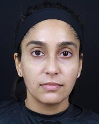 Skin Rejuvenation Before & After