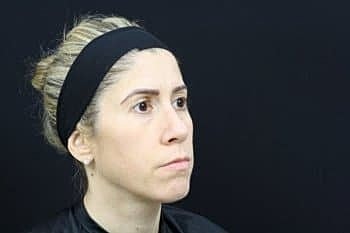 Skin Rejuvenation Before & After