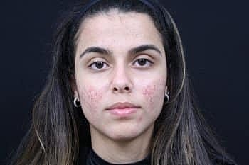 Skin Rejuvenation Before & After