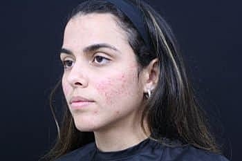 Skin Rejuvenation Before & After