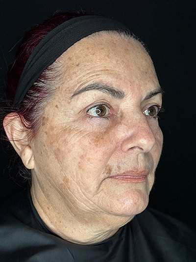 Skin Rejuvenation  Before & After