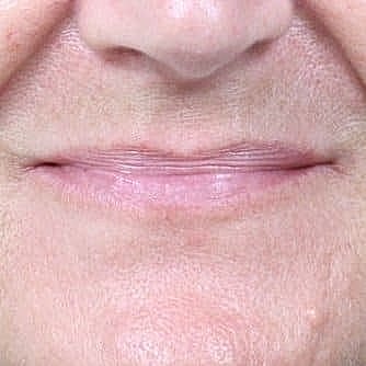 Close-up of lips and chin area.