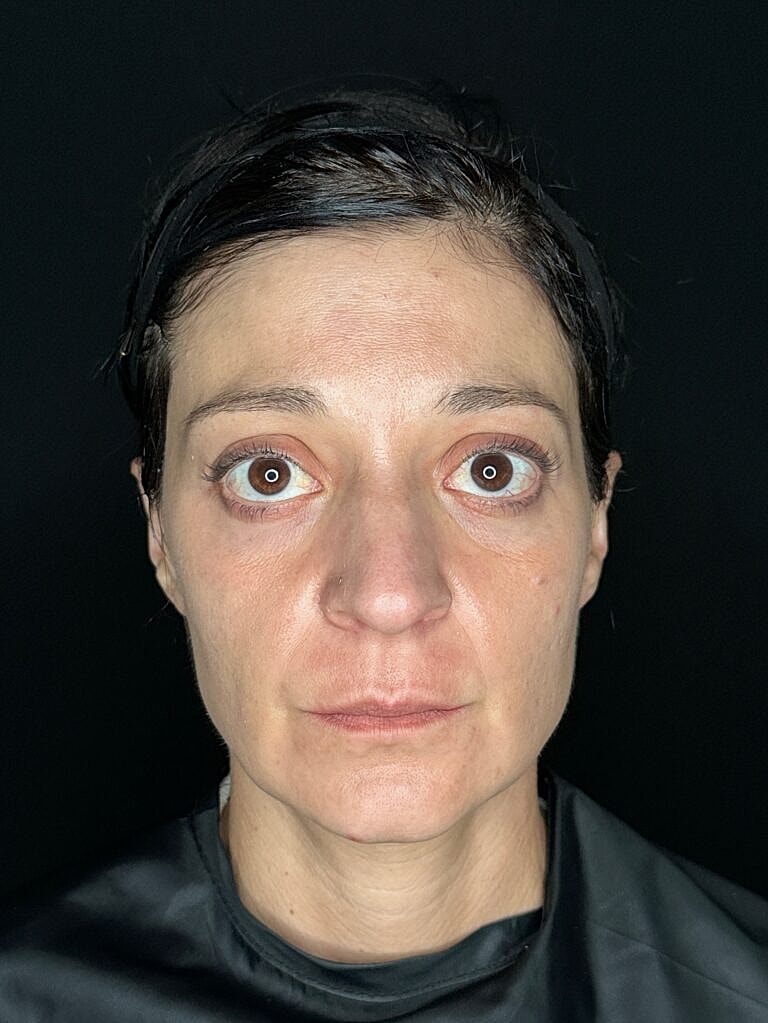 Facial Rejuvenation Before & After