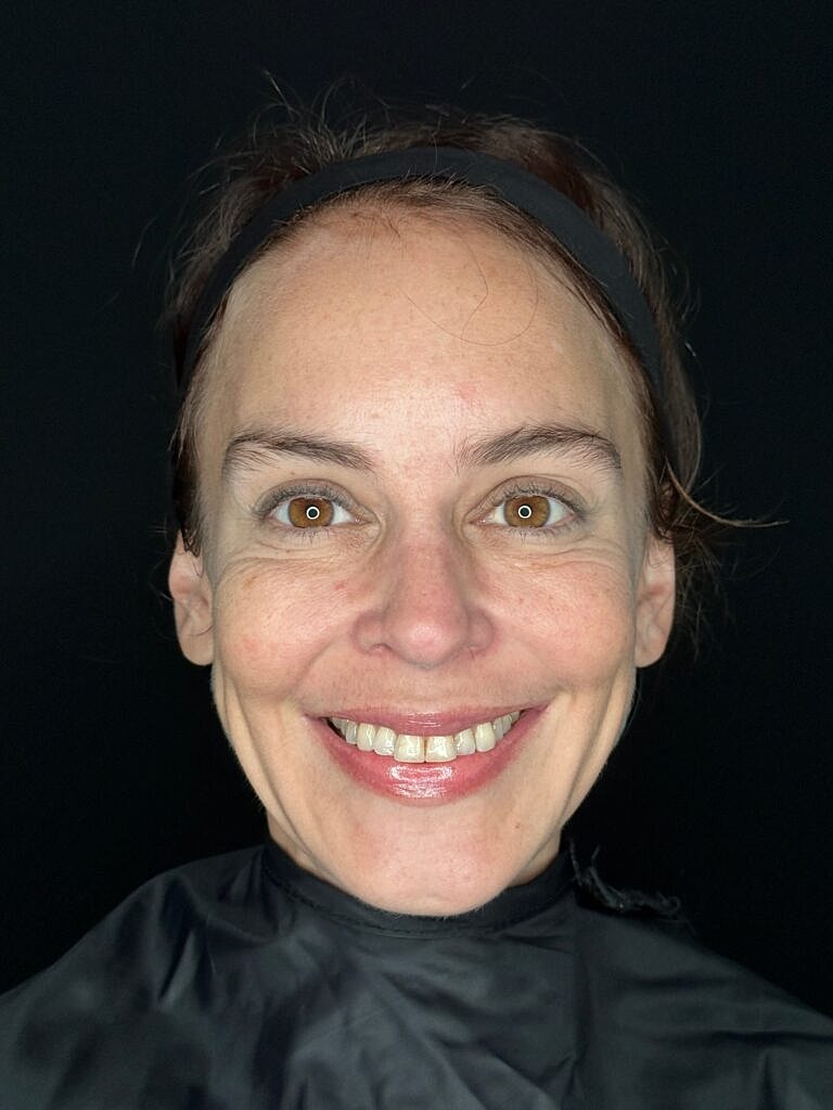 Facial Rejuvenation Before & After