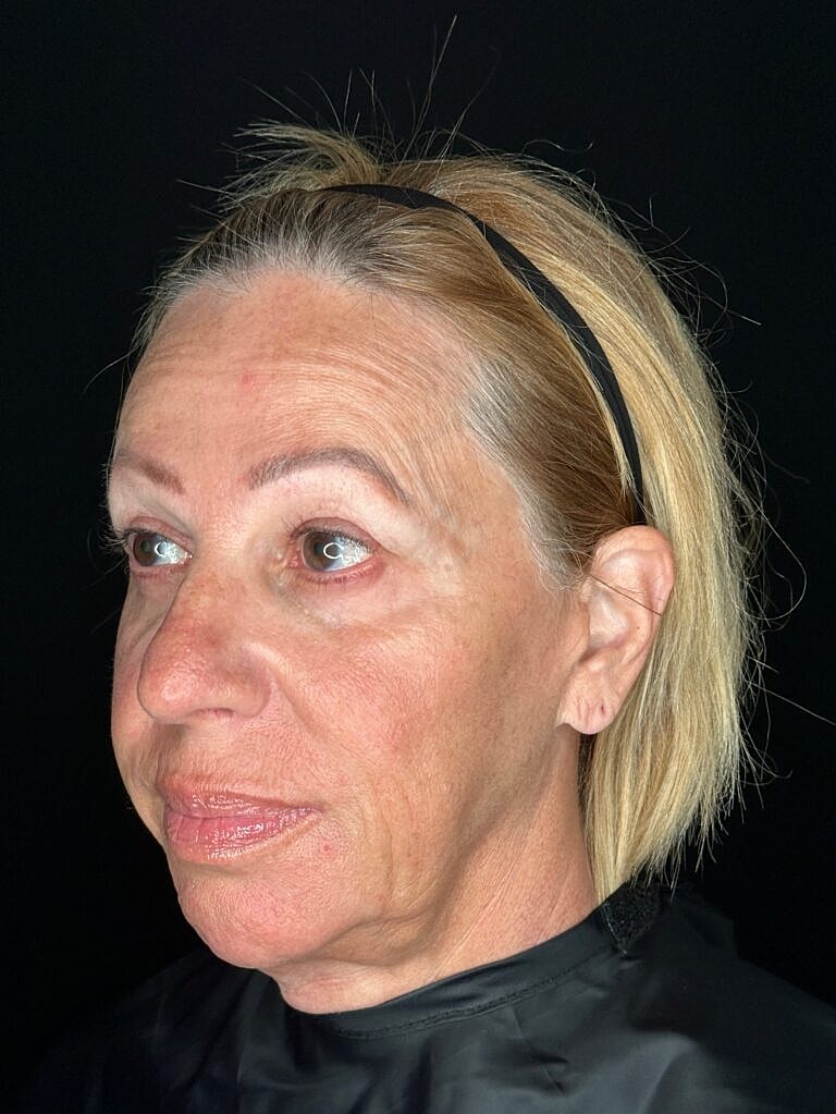 Thermage Before & After