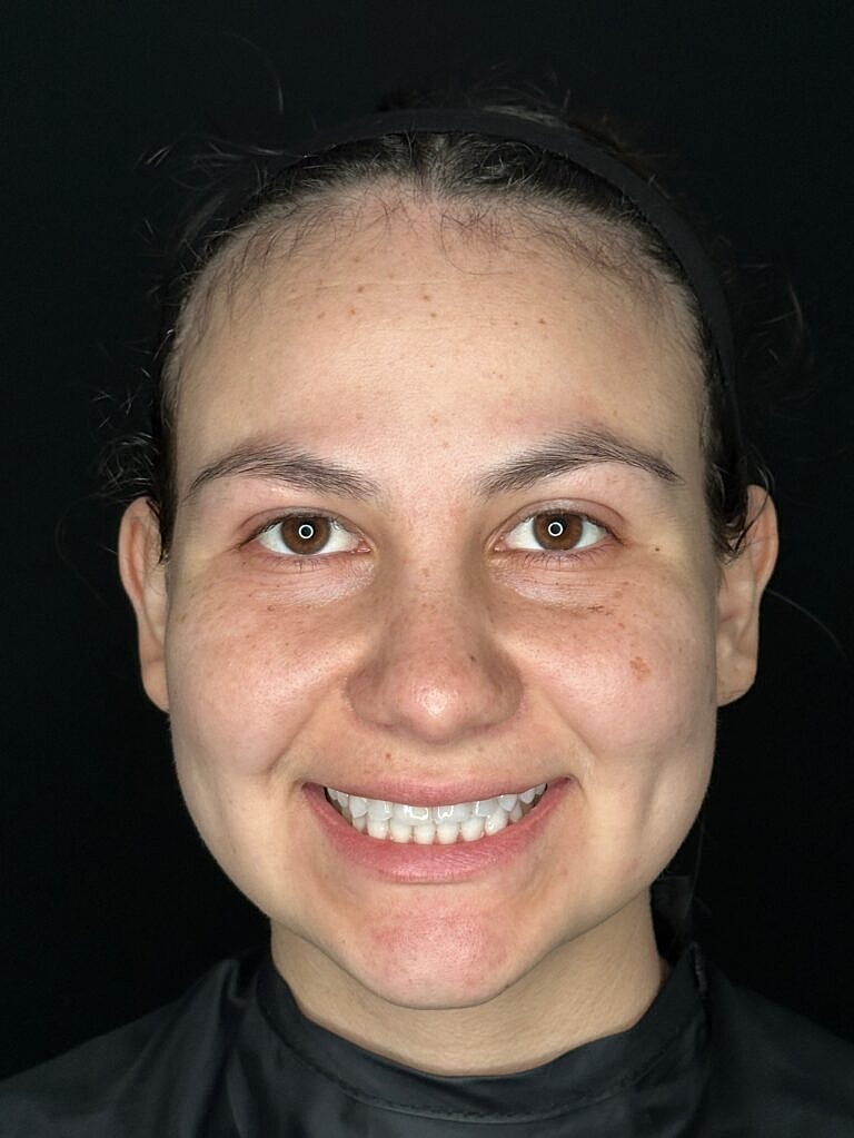 Thermage Before & After