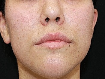 Close-up of a woman's face with uneven skin tone.