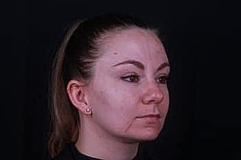 Profile view of a woman with facial scars.