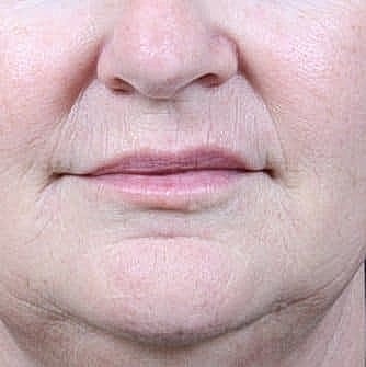 Close-up of mature woman's lower face.