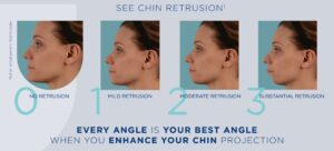 treat chin retrusion using chin filler restylane defyne