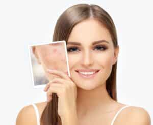 Post acne,Marks,,treating,Acne,Scars.acne,Scar,Removal