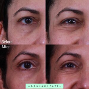 Raising eyebrow and opening up eye with Dysport and Sculptra