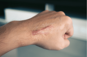 Scar on human skin keloid on hand.